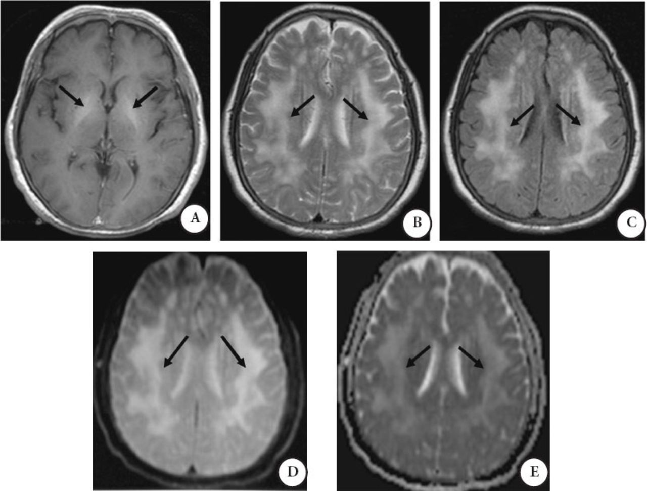 Hepatic encephalopathy coexists with acquired chronic hepatocerebral ...