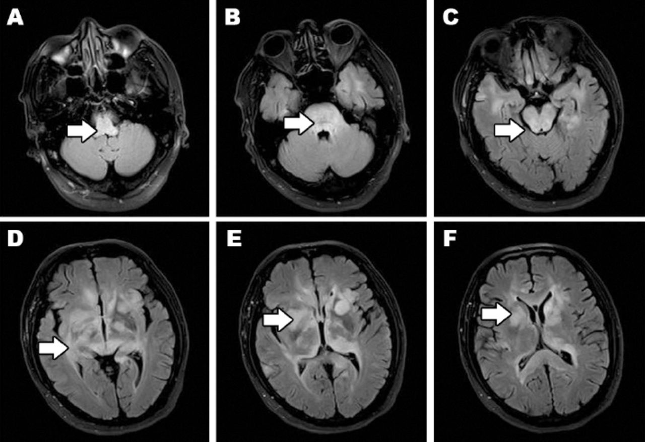 A rare case of nonenhancing primary central nervous system lymphoma ...