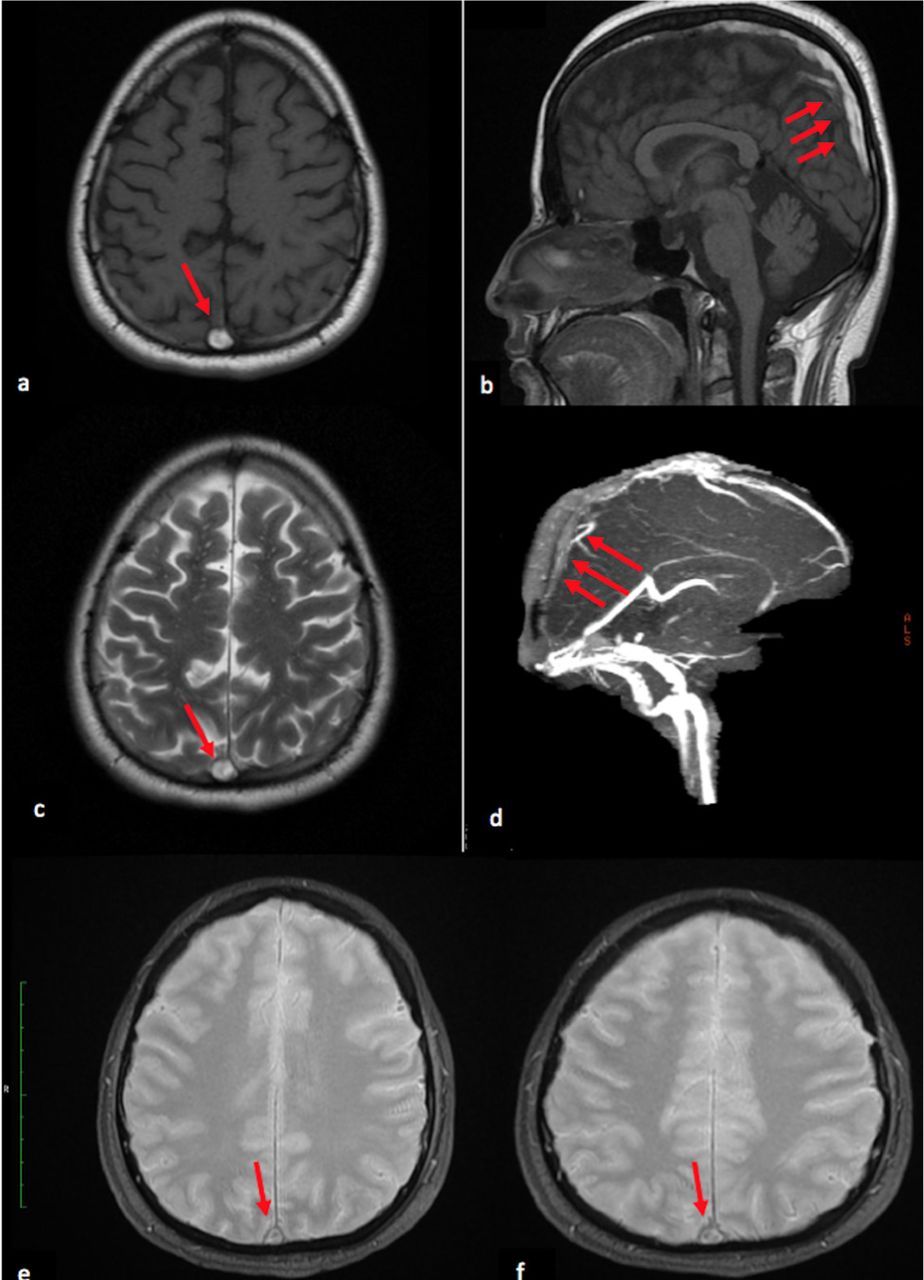 Superior Sagittal Sinus Thrombosis After Spinal Anesthesia Neurosciences Journal 4179