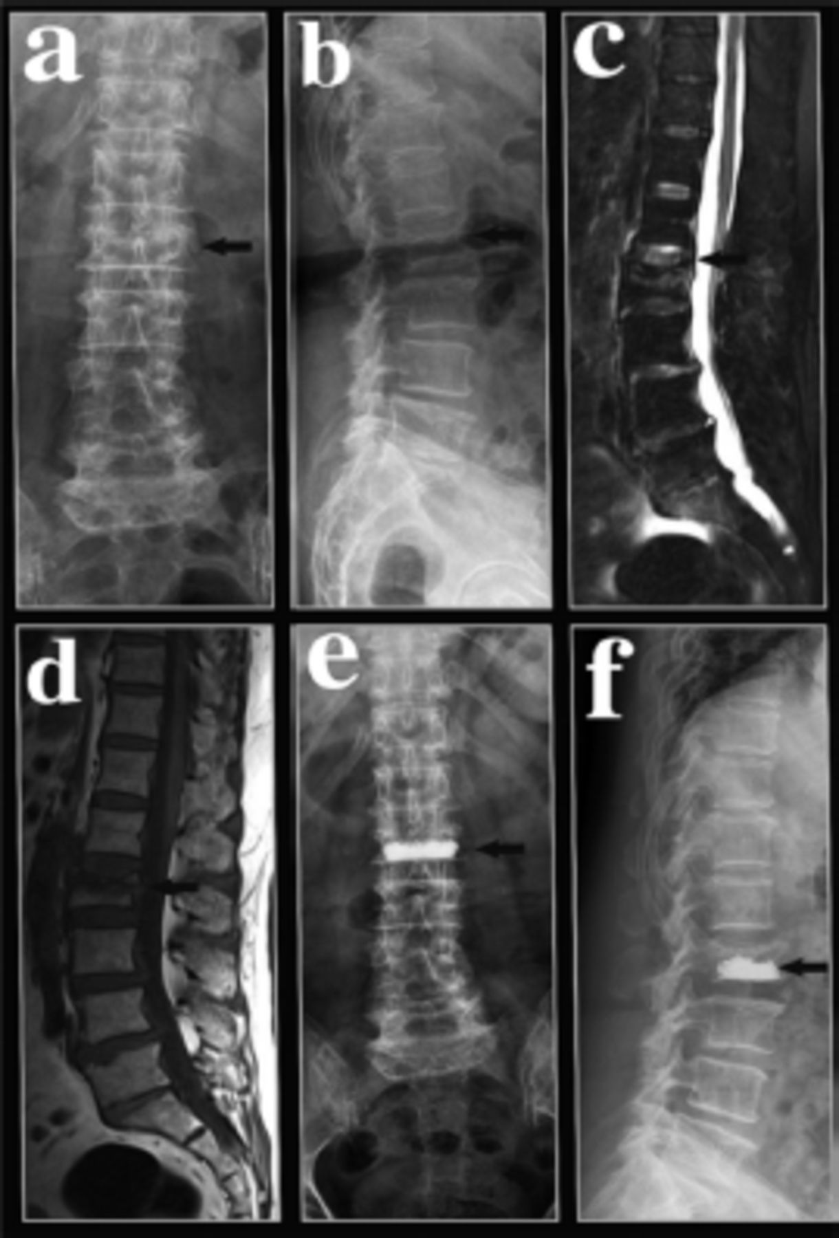 Plateau Aanvrager terwijl Comparison of unilateral and bilateral puncture percutaneous kyphoplasty in  the treatment of osteoporotic vertebral compression fractures |  Neurosciences Journal